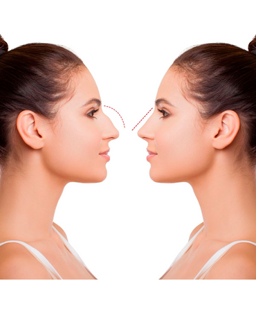 RULAV CORRECTOR NASAL PEQUEÑO